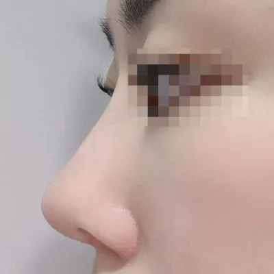 気に入っています！一ヶ月後の腫れが引いた時がとても楽しみです！