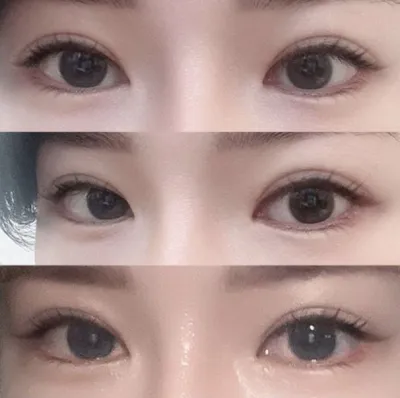 再手術が必要ならみんなウィーバースに行ってください!!www