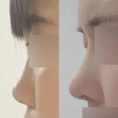 目と鼻の手術を受けてからもう8ヶ月になりました！