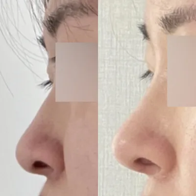 長年のコンプレックスだった鼻、ついに手術しました〜