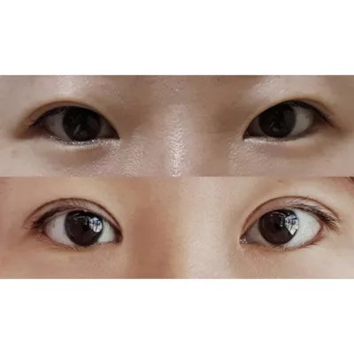 目の手術を受けてから1ヶ月ちょっと経ちました