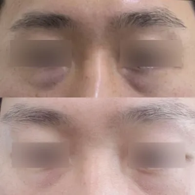 目の下の脂肪再配置手術2ヶ月目のレビューです:)