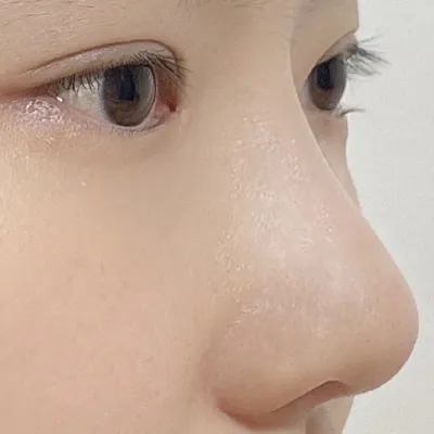 ウォルヘで4月に目と鼻の手術を受けて2ヶ月目です（笑）