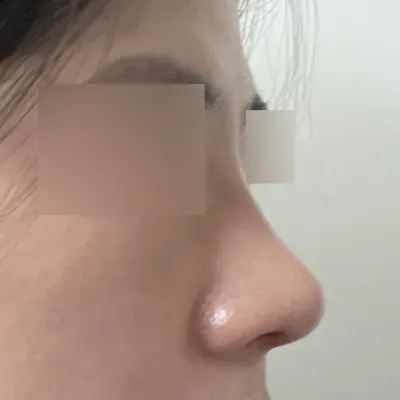 団子鼻の手術を受けました