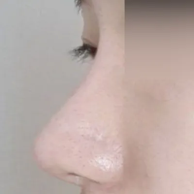 鼻炎手術と鼻整形を一緒にしました！