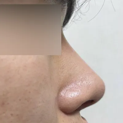 シム院長に鼻の手術を受けて2ヶ月目です