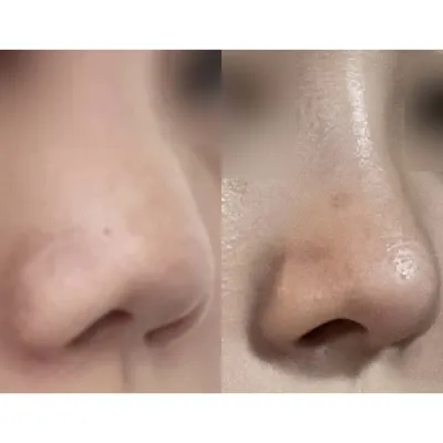 鼻の手術を受けてから1ヶ月ちょっと経ちました！