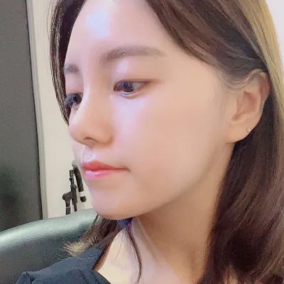 ウィーバース美容外科で鼻の手術をして1ヶ月目です