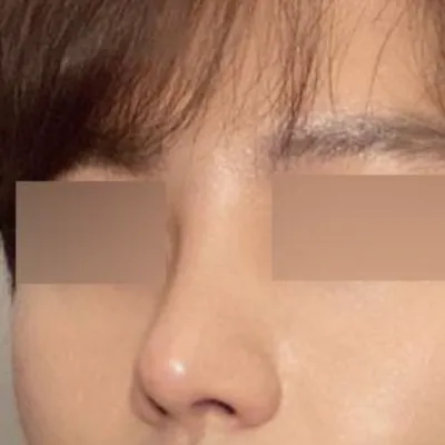 鼻の3回目の再手術 / 目の初回手術のレビュー