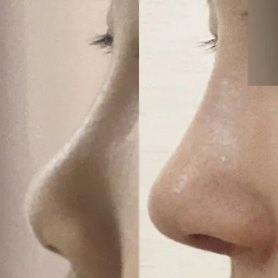 シム・ジョンファン院長に手術を受けてから2週間目です