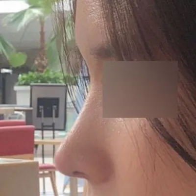 밋밋だった魔女鼻の手術を受けました