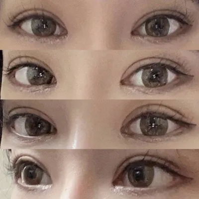 左右の目の矯正をしました!