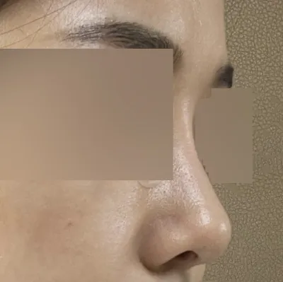 手術から3ヶ月ちょっと経ったレビューです〜