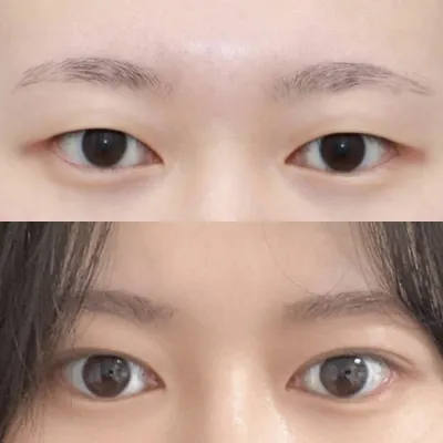 手術後3ヶ月目のレビュー