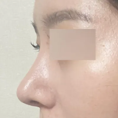 広がった団子鼻の手術から2週間目です