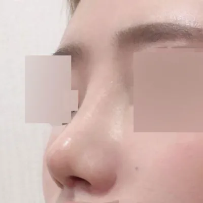 団子鼻の再手術を受けました！